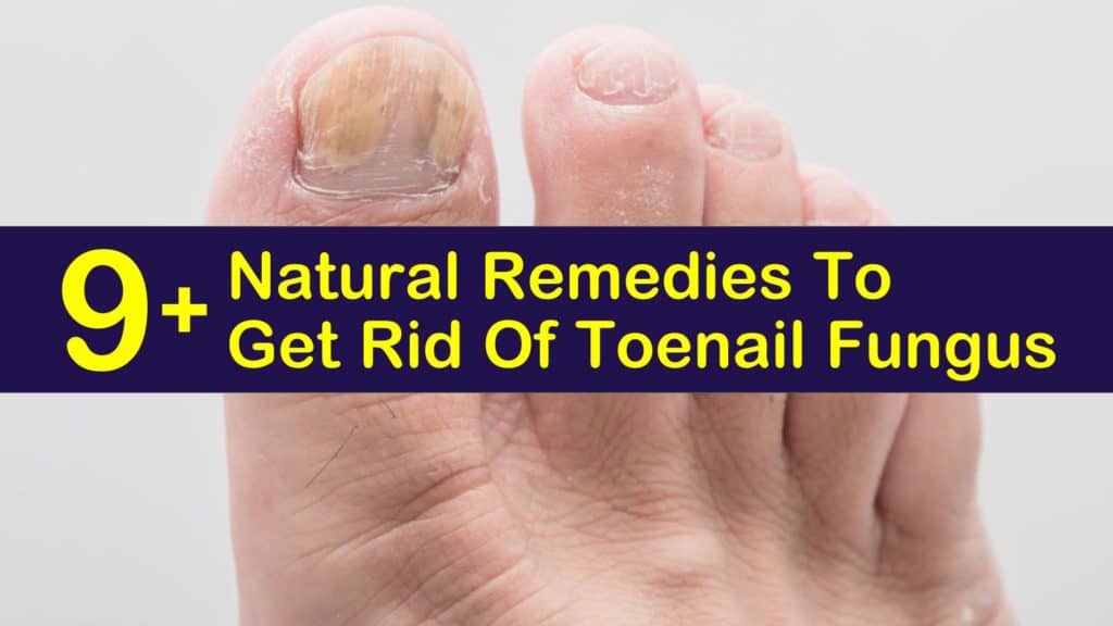 9+ Natural Remedies To Get Rid Of Toenail Fungus